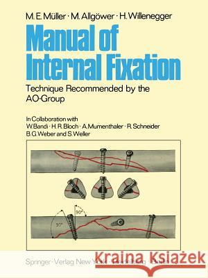 Manual of Internal Fixation: Technique Recommended by the Ao-Group Swiss Association for the Study of Internal Fixation: Asif Schatzker, Joseph 9783642960673 Springer - książka