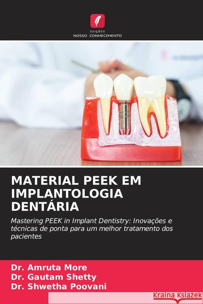 Material Peek Em Implantologia Dent?ria Amruta More Gautam Shetty Shwetha Poovani 9786208329327 Edicoes Nosso Conhecimento - książka