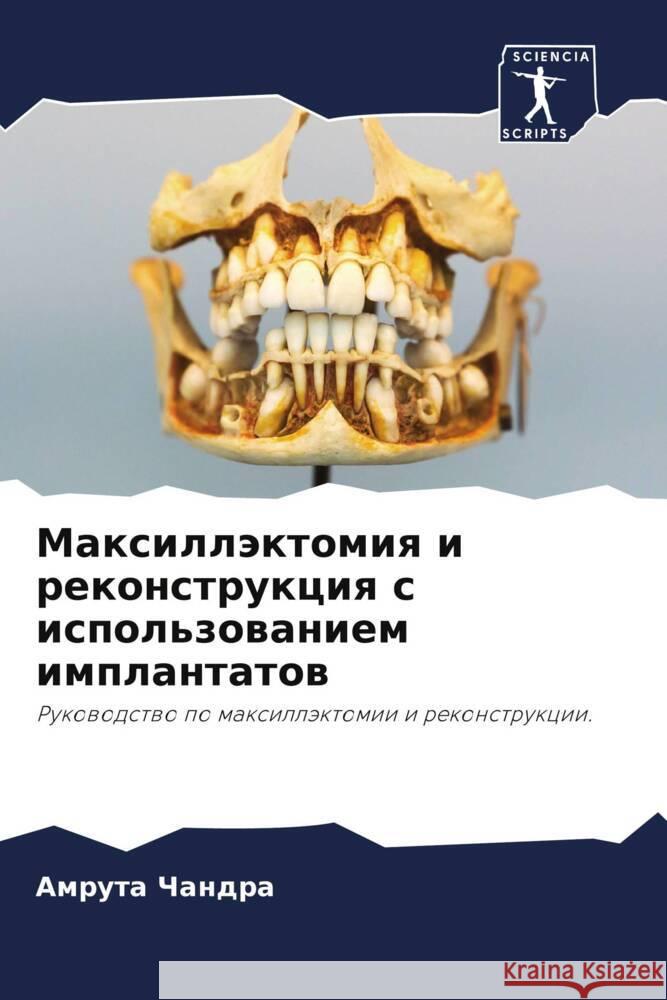 Maxilläktomiq i rekonstrukciq s ispol'zowaniem implantatow Chandra, Amruta 9786203616781 Sciencia Scripts - książka