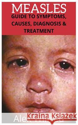 Measles: Guide to Symptoms, Causes, Diagnosis & Treatment Alex Wilfred 9781795319232 Independently Published - książka