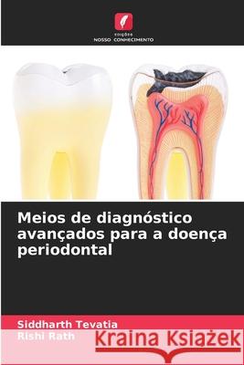 Meios de diagnóstico avançados para a doença periodontal Tevatia, Siddharth, Rath, Rishi 9786203917734 Edições Nosso Conhecimento - książka