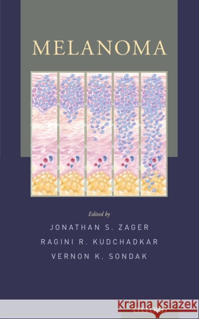Melanoma Vernon K. Sondak Jonathan S. Zager Ragini Kudchadkar 9780199971015 Oxford University Press, USA - książka