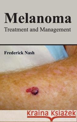 Melanoma: Treatment and Management Frederick Nash 9781632422729 Foster Academics - książka