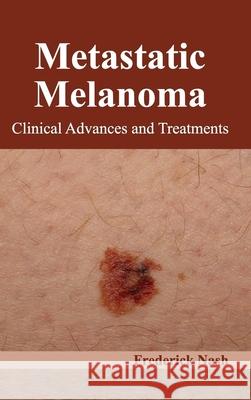 Metastatic Melanoma: Clinical Advances and Treatments Frederick Nash 9781632422767 Foster Academics - książka