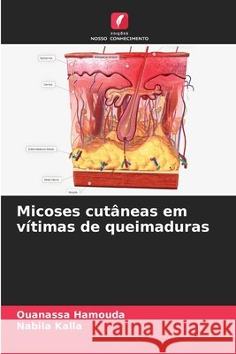 Micoses cutâneas em vítimas de queimaduras Hamouda, Ouanassa, Kalla, Nabila 9786208944209 Edições Nosso Conhecimento - książka
