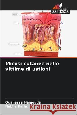 Micosi cutanee nelle vittime di ustioni Hamouda, Ouanassa, Kalla, Nabila 9786208944247 Edizioni Sapienza - książka