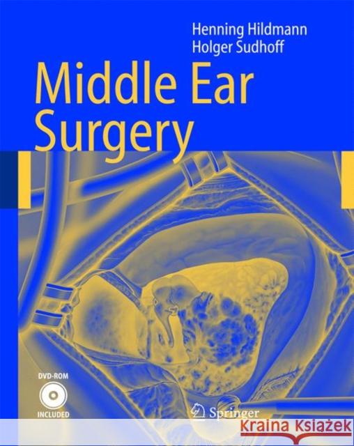 Middle Ear Surgery [With DVD] Hildmann, Henning 9783540222019 Springer - książka