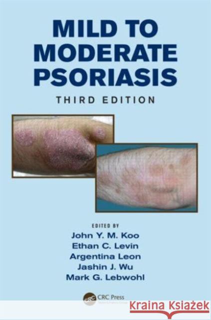 Mild to Moderate Psoriasis John Y. M. Koo Ethan C. Levin Argentina Leon 9781482215083 Taylor and Francis - książka