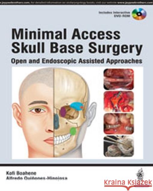 Minimal Access Skull Base Surgery: Open and Endoscopic Assisted Approaches Kofi Boahene 9789351529347 Jaypee Brothers, Medical Publishers Pvt. Ltd. - książka