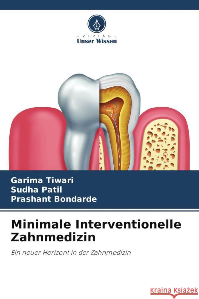 Minimale Interventionelle Zahnmedizin Tiwari, Garima, Patil, Sudha, Bondarde, Prashant 9786205060278 Verlag Unser Wissen - książka