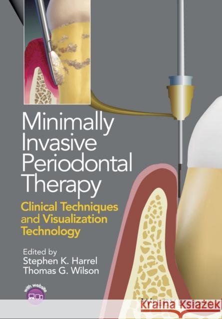 Minimally Invasive Periodontal Therapy: Clinical Techniques and Visualization Technology Harrel, Stephen K.; Wilson, Thomas G. 9781118607626 John Wiley & Sons - książka
