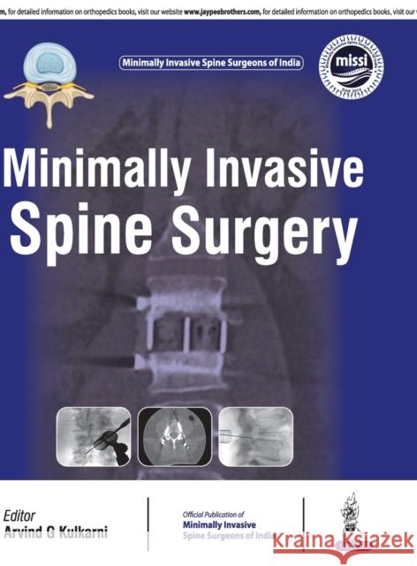Minimally Invasive Spine Surgery Arvind Kulkarni 9789352700547 Jp Medical Ltd - książka