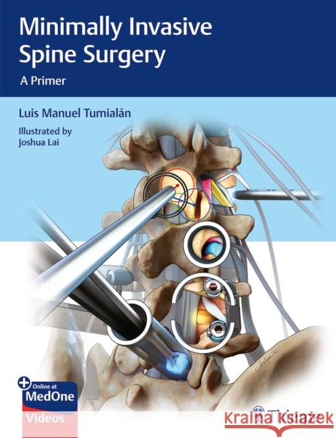Minimally Invasive Spine Surgery: A Primer Tumialan, Luis Manuel 9781626232181 Thieme Medical Publishers - książka