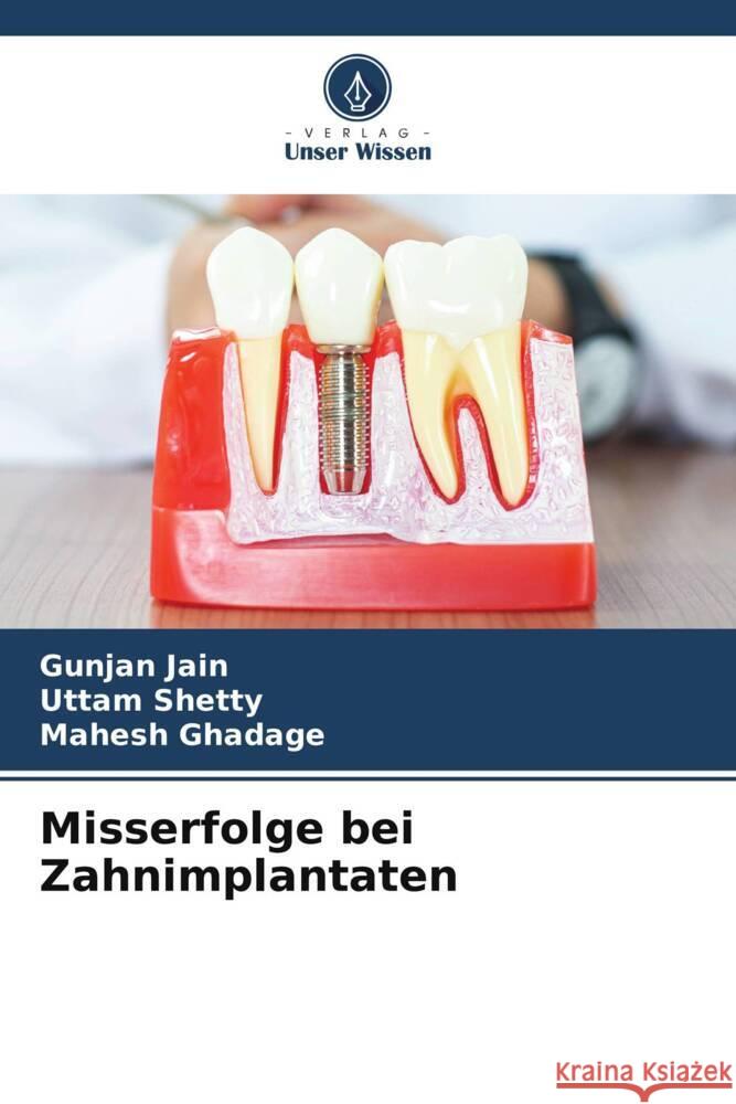 Misserfolge bei Zahnimplantaten Jain, Gunjan, Shetty, Uttam, Ghadage, Mahesh 9786205065679 Verlag Unser Wissen - książka