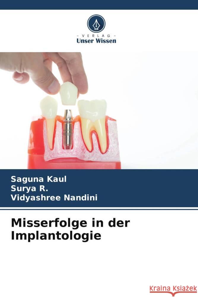 Misserfolge in der Implantologie Kaul, Saguna, R., Surya, Nandini, Vidyashree 9786206307044 Verlag Unser Wissen - książka