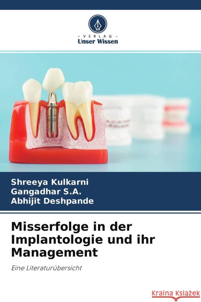 Misserfolge in der Implantologie und ihr Management Kulkarni, Shreeya, S.A., Gangadhar, Deshpande, Abhijit 9786204240343 Verlag Unser Wissen - książka