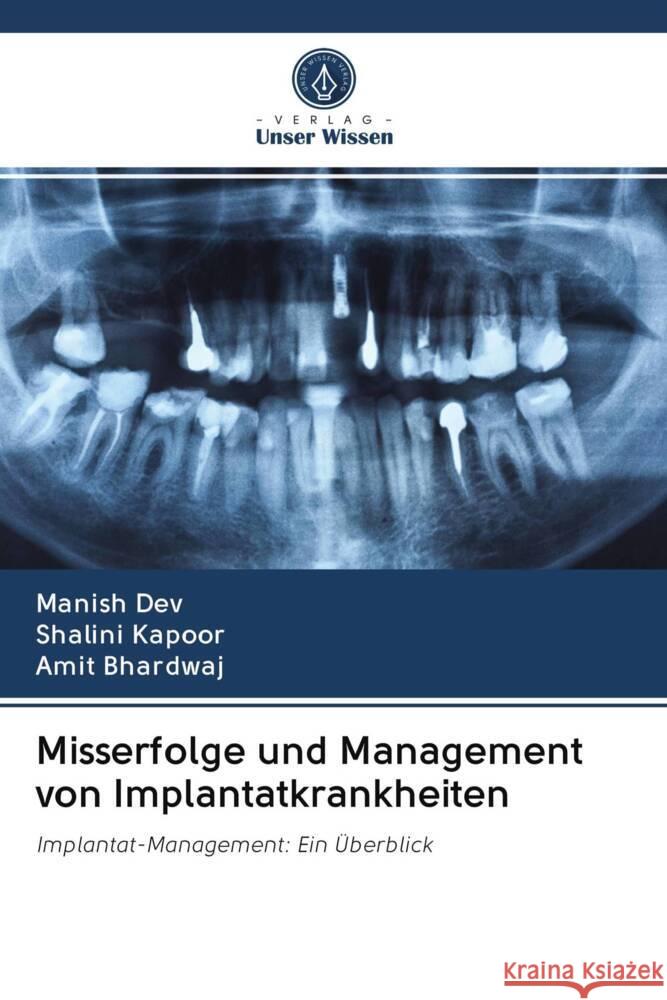 Misserfolge und Management von Implantatkrankheiten Dev, Manish, Kapoor, Shalini, Bhardwaj, Amit 9786203050684 Verlag Unser Wissen - książka