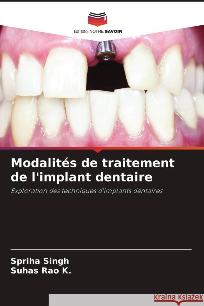 Modalit?s de traitement de l'implant dentaire Spriha Singh Suhas Rao K 9786208069360 Editions Notre Savoir - książka