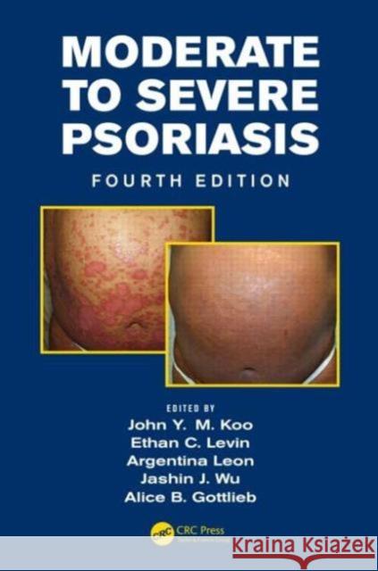 Moderate to Severe Psoriasis John Y. M. Koo Ethan Levin Argentina Leon 9781482215168 Apple Academic Press Inc. - książka