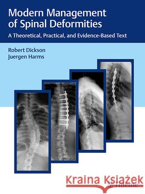 Modern Management of Spinal Deformities : A Theoretical, Practical, and Evidence-based Text Robert A. Dickson Jurgen Harms 9783132016316 Tps - książka