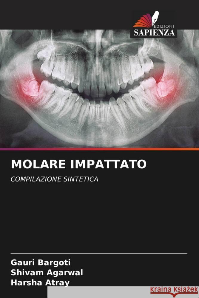 MOLARE IMPATTATO Bargoti, Gauri, Agarwal, Shivam, Atray, Harsha 9786204857794 Edizioni Sapienza - książka