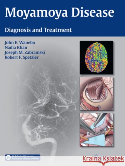 Moyamoya Disease: Diagnosis and Treatment Wanebo, John E. 9781604067309 Thieme Medical Publishers - książka