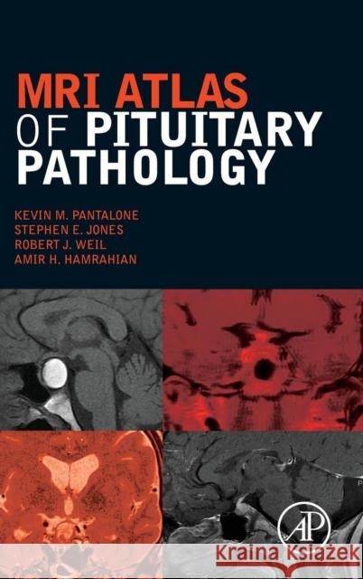 MRI Atlas of Pituitary Pathology Hamrahian, Amir H. Pantalone, Kevin M. Weil, Robert J. 9780128025772 Elsevier Science - książka