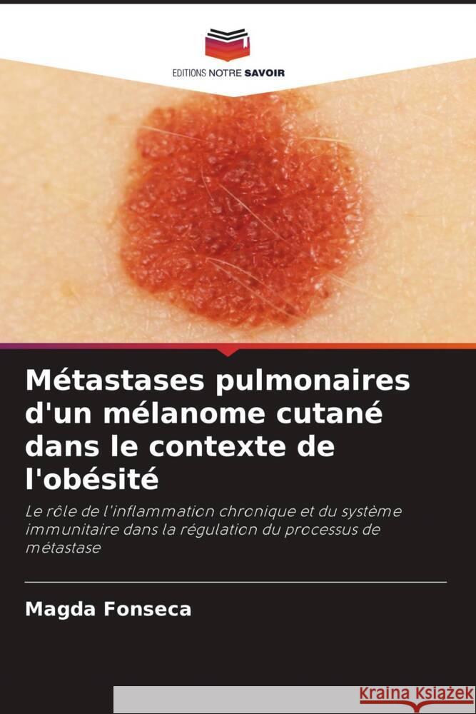 Métastases pulmonaires d'un mélanome cutané dans le contexte de l'obésité Fonseca, Magda 9786206909316 Editions Notre Savoir - książka