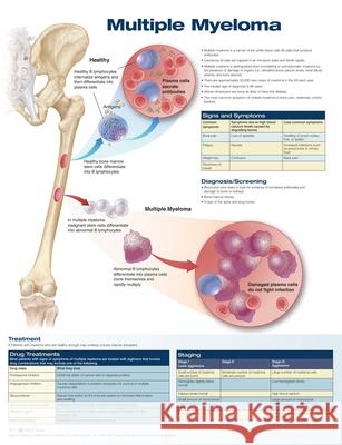 Multiple Myeloma Anatomical Chart Company   9781496369512 Lippincott Williams and Wilkins - książka