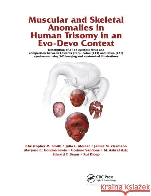 Muscular and Skeletal Anomalies in Human Trisomy in an Evo-Devo Context: Description of a T18 Cyclopic Fetus and Comparison Between Edwards (T18), Pat Rui Diogo Christopher M. Smith Janine M. Ziermann 9780367377793 CRC Press - książka
