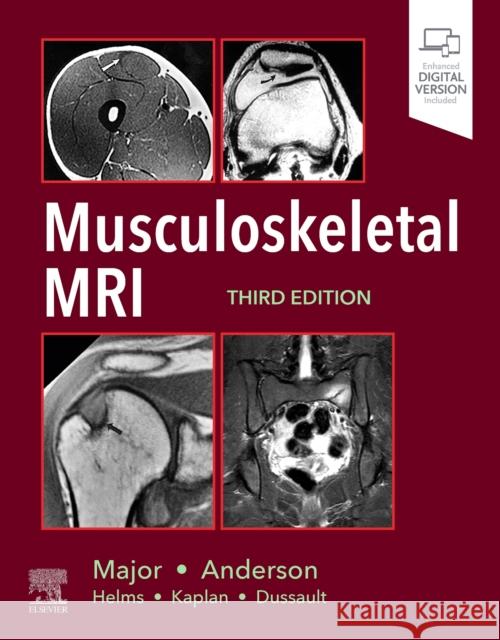 Musculoskeletal MRI Nancy M. Major Mark W. Anderson 9780323415606 Elsevier - książka