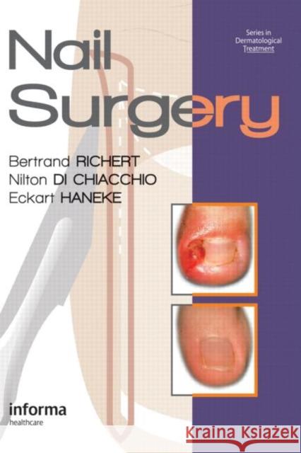 Nail Surgery Bertrand Richert Nilton D Eckart Haneke 9780415472333 Informa Healthcare - książka