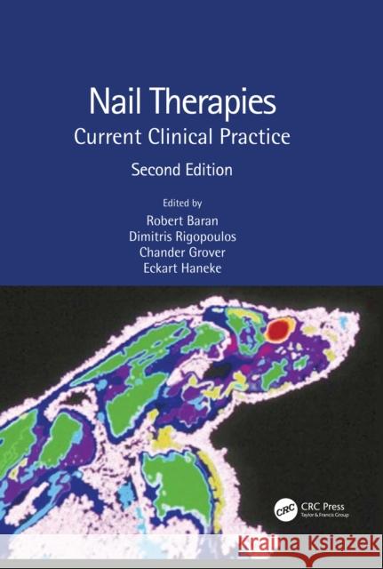 Nail Therapies: Current Clinical Practice Robert Baran Dimitris Rigopoulos Chander Grover 9780367334796 CRC Press - książka