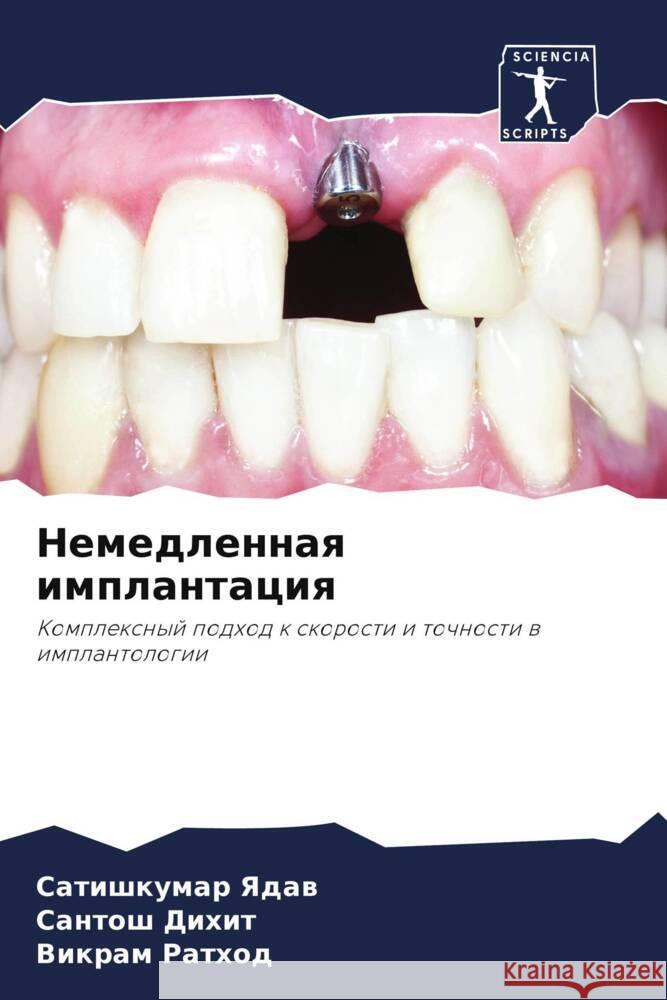 Nemedlennaq implantaciq Yadaw, Satishkumar, Dihit, Santosh, Rathod, Vikram 9786208060497 Sciencia Scripts - książka