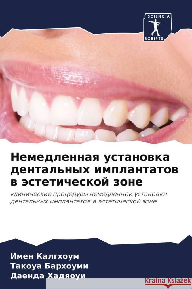 Nemedlennaq ustanowka dental'nyh implantatow w ästeticheskoj zone Kalghoum, Imen, Barhoumi, Takoua, Hadqoui, Daenda 9786206435105 Sciencia Scripts - książka