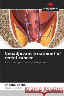 Neoadjuvant treatment of rectal cancer Bacha, Dhouha, Jedidi, Malek 9786208496579 Our Knowledge Publishing - książka