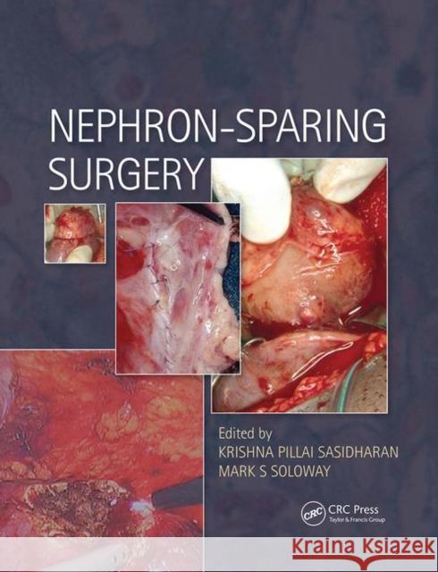 Nephron-Sparing Surgery Krishna Sasidharan Mark Soloway (University of Miami, FL US  9780367446185 CRC Press - książka