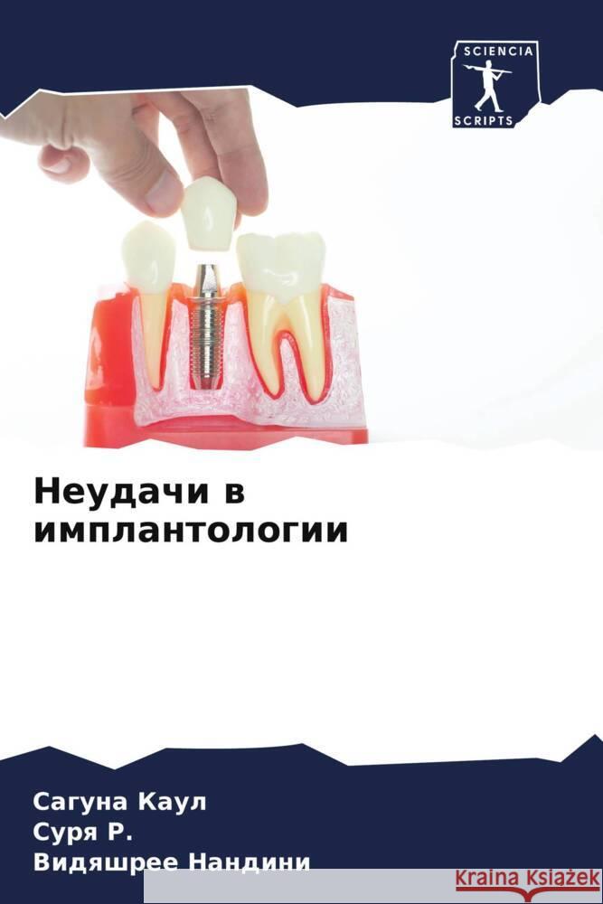 Neudachi w implantologii Kaul, Saguna, R., Surq, Nandini, Vidqshree 9786206307143 Sciencia Scripts - książka