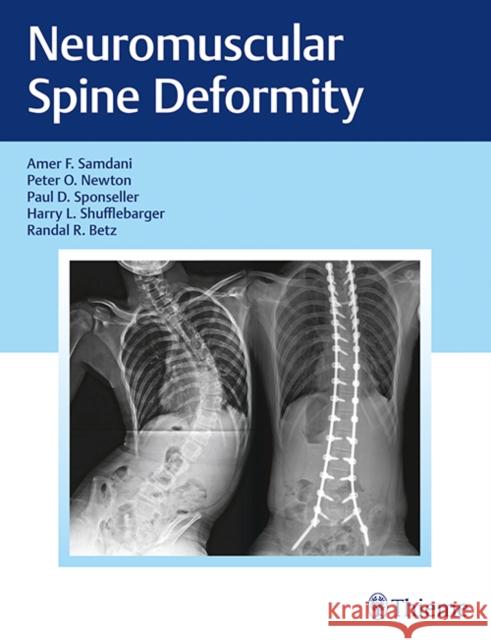 Neuromuscular Spine Deformity Amer Samdani Peter O. Newton Harry L. Shufflebarger 9781626232600 Thieme Medical Publishers - książka