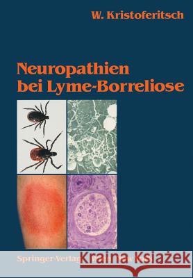 Neuropathien Bei Lyme-Borreliose Wolfgang Kristoferitsch W. Burgdorfer 9783211821084 Springer - książka