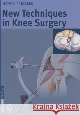 New Techniques in Knee Surgery H. H. Paessler H. Thermann 9783642632518 Steinkopff-Verlag Darmstadt - książka