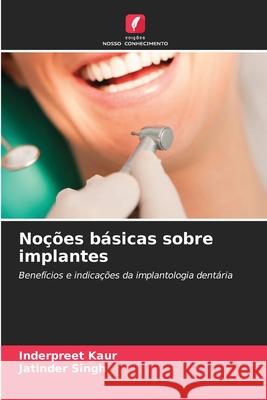 No??es b?sicas sobre implantes Inderpreet Kaur Jatinder Singh 9786202209380 Edicoes Nosso Conhecimento - książka