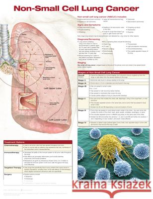 Non-Small Cell Lung Cancer Anatomical Chart Company   9781496369529 Lippincott Williams and Wilkins - książka