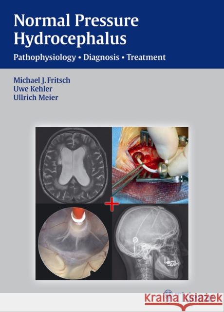 Normal Pressure Hydrocephalus: Pathophysiology - Diagnosis - Treatment Fritsch, Michael J. 9783131646019 Thieme Medical Publishers - książka