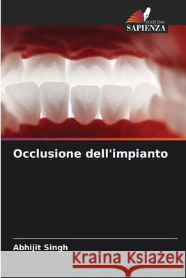 Occlusione dell'impianto Singh, Abhijit 9786208885151 Edizioni Sapienza - książka