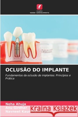 OCLUSÃO DO IMPLANTE Ahuja, Neha, Girdhar, ANU, Kaur Mann, Navneet 9786208715731 Edições Nosso Conhecimento - książka