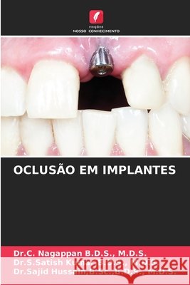 Oclusão Em Implantes M D S Dr C Nagappan B D S, B D S M D S Kumar, B Sc B D S Hussain 9786203948608 Edicoes Nosso Conhecimento - książka