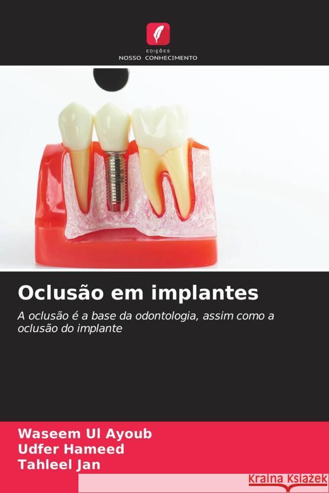 Oclusão em implantes Ul Ayoub, Waseem, Hameed, Udfer, Jan, Tahleel 9786204641843 Edições Nosso Conhecimento - książka