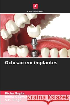 Oclus?o em implantes Richa Gupta Roma Goswami S. P. Singh 9786208937751 Edicoes Nosso Conhecimento - książka