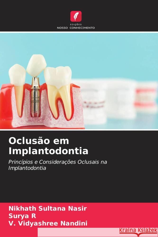 Oclusão em Implantodontia Sultana Nasir, Nikhath, R, Surya, Nandini, V. Vidyashree 9786204767918 Edições Nosso Conhecimento - książka